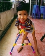 Young victim of Agent Orange dioxins in Vietnam