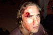 One of the many yet far from the worst injury from the recent police attack at  Occupy Oakland