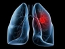 Lung cancer