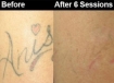 tattoo removal