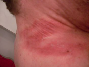 Second degree burns on Wayne Madsen's right shoulder and neck after January 2011 warning of increased NSA phone surveillance.