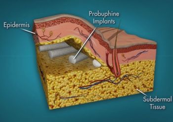 buprenorphine 